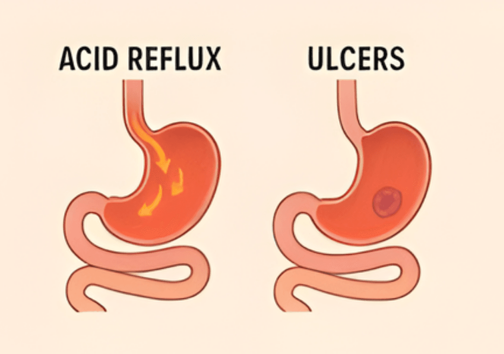 Acid reflux & peptic ulcer disease