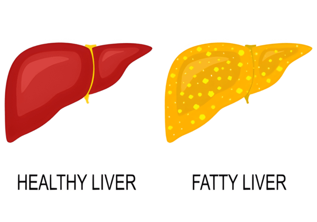 fatty liver