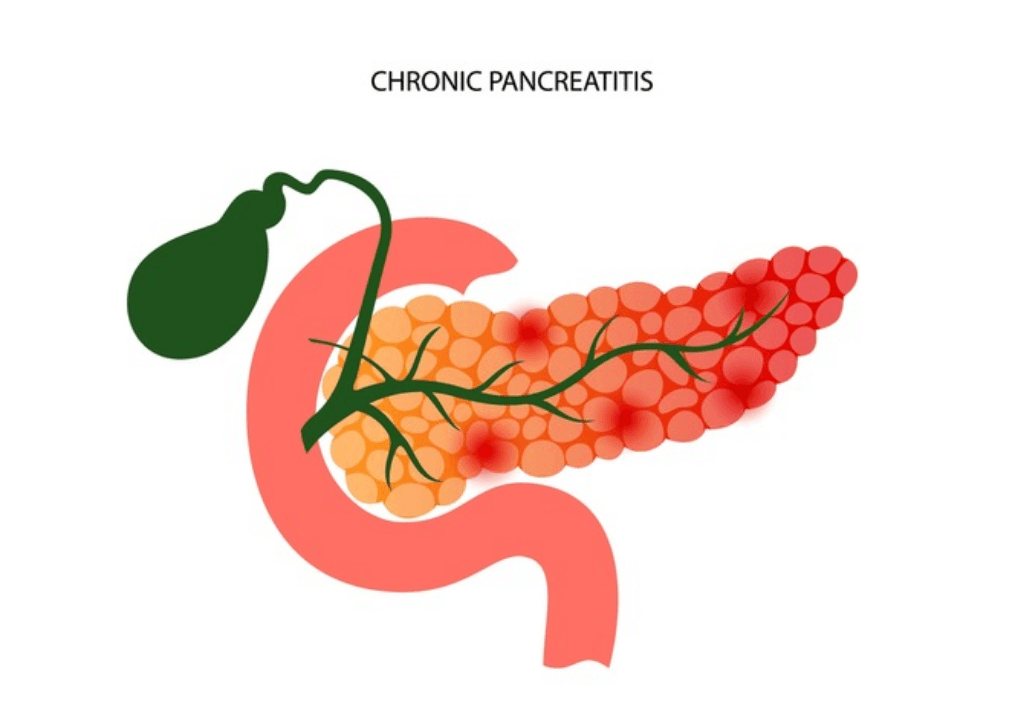 Pancreatitis