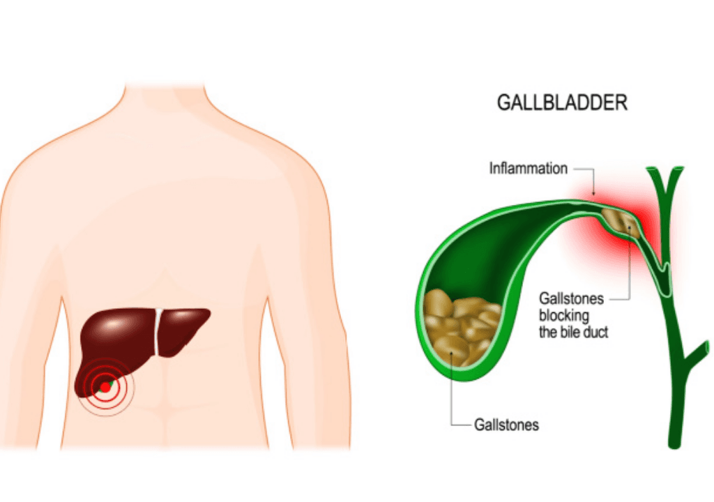Gallstones & biliary disorders