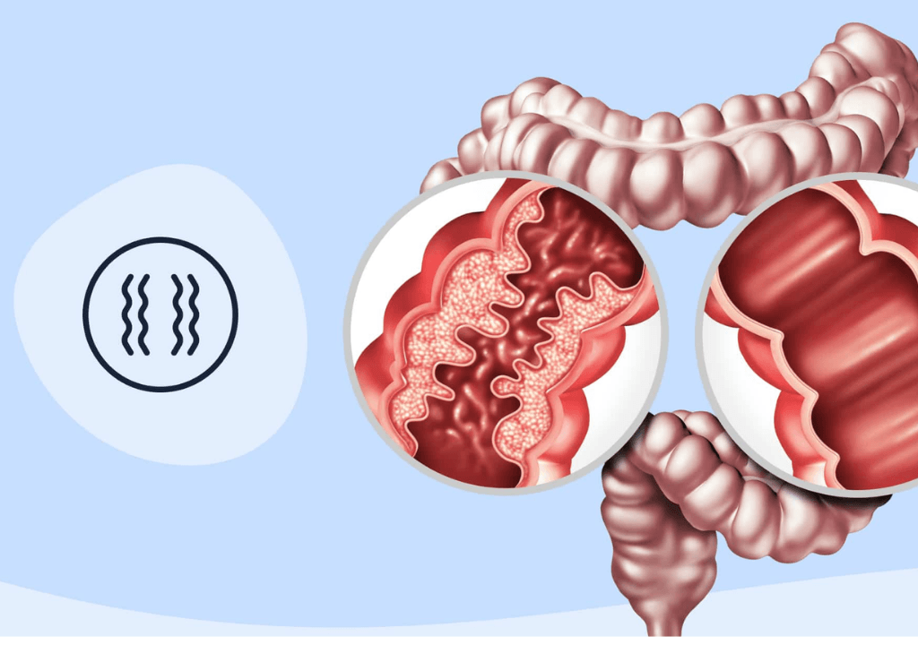 Inflammatory bowel disease